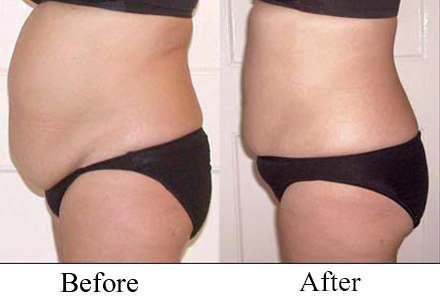 fat reduction  for women1