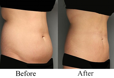 fat reduction  for women2