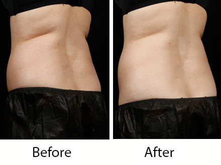 fat reduction  for women1